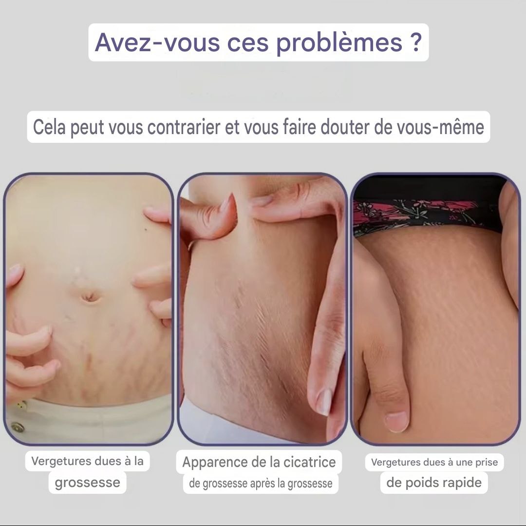 la solution dermatologique qui élimine vraiment les vergetures, les chéloïdes, les cicatrices et l'acné tenace